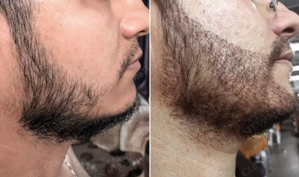 ​Beard Transplant Turkey before and after