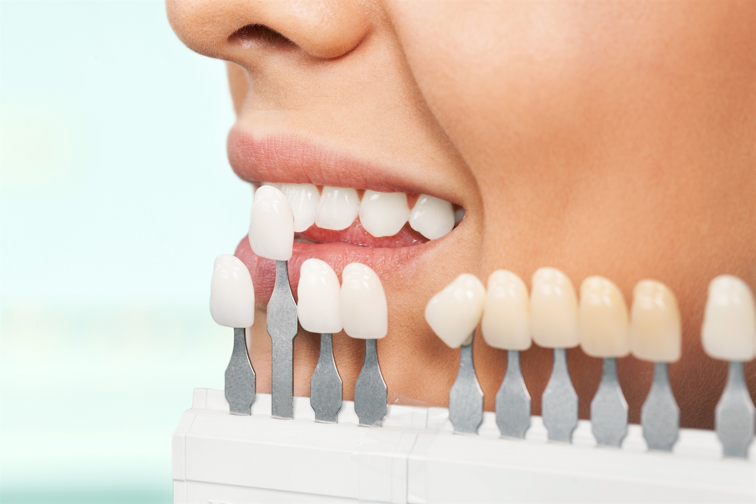  Dental Veener in Turkey cost before and after 