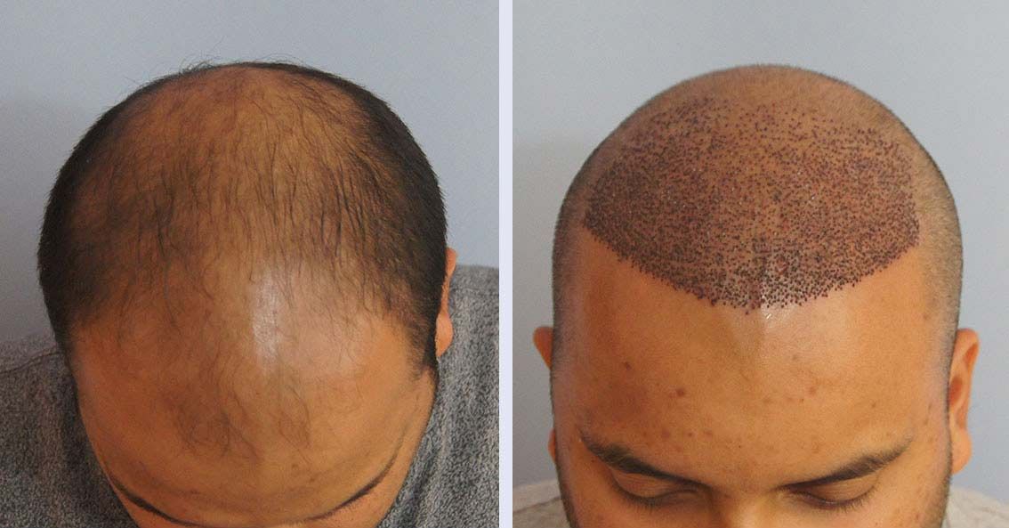 ​Fue Hair Transplant Turkey before and after