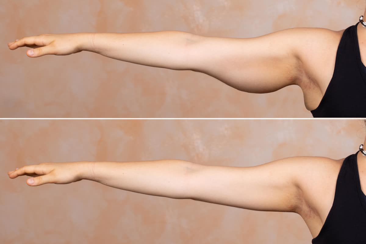 ​Arm Lift Turkey before and after photos