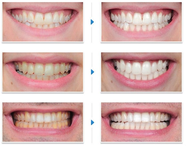 Teeth Whitening in Turkey before and after 
