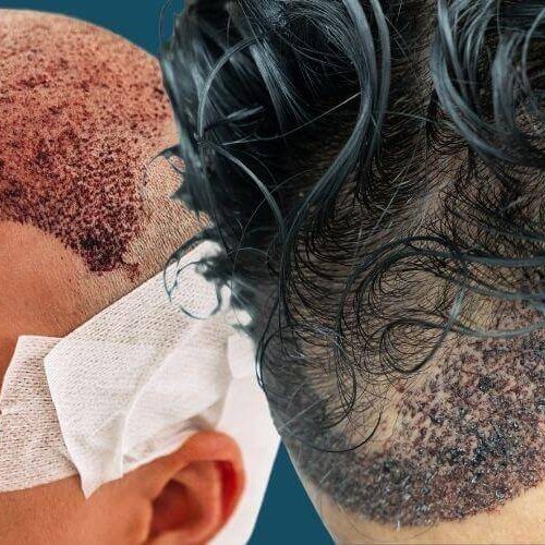 زراعة الشعر بتقنية fue مقابل fut للنساء