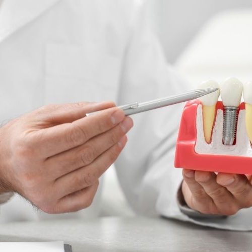 latest-developments-in-dental-implant-technology-dental-implant-treatment-in-turkey-00