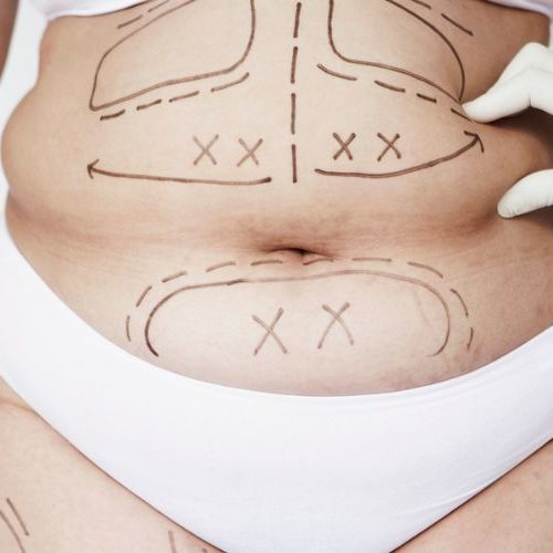 liposuction-for-women-body-sculpting-options-and-benefits-00