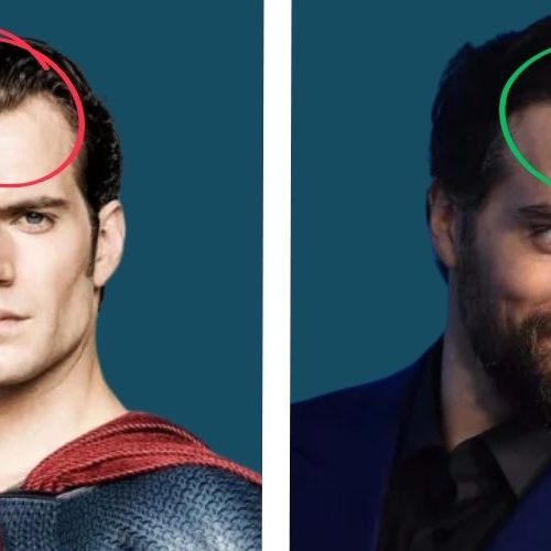 what-you-need-to-know-about-henry-cavill-hair-transplant-00